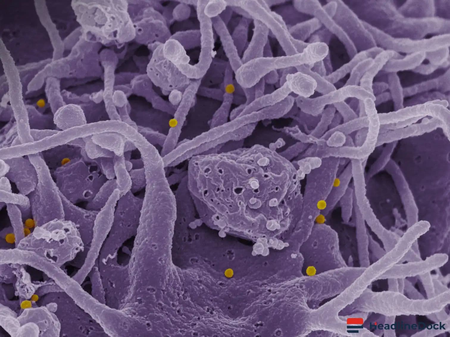 New Case of Crimean-Congo Hemorrhagic Fever Confirmed in Spain's Salamanca Province